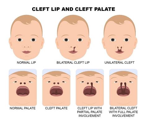 Clefts .